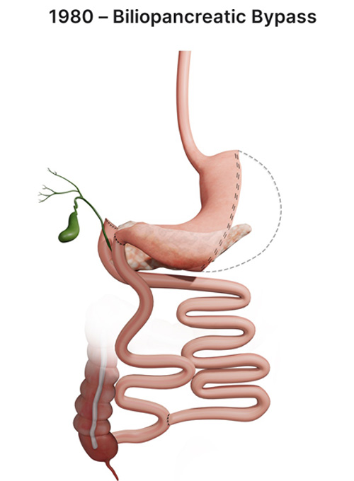 Sleeve bariatric procedures