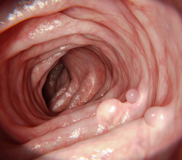 Colon polyp