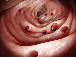 Diverticulitis of Colon