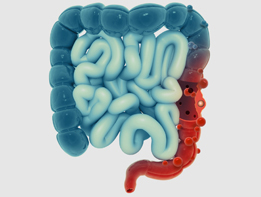 Diverticulitis of Colon