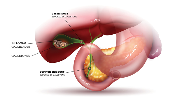 Gallbladder Disorders1