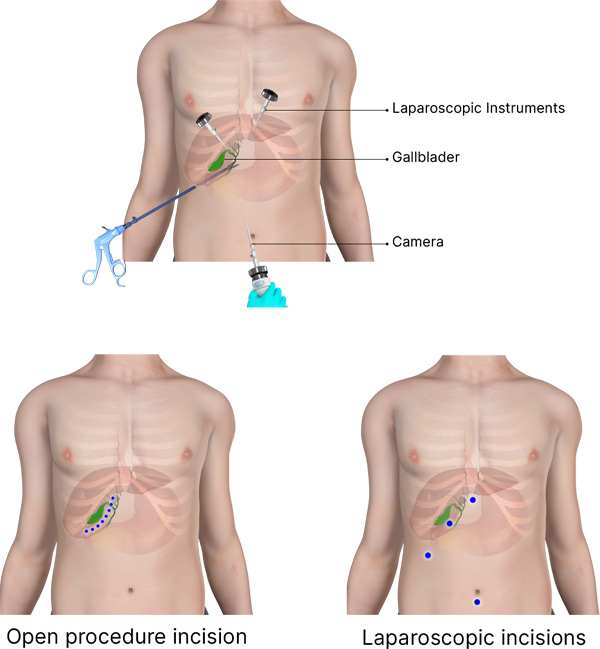 Gallbladder Disorders3