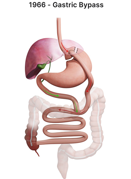 Sleeve bariatric procedures
