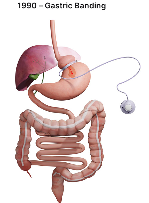 Sleeve bariatric procedures