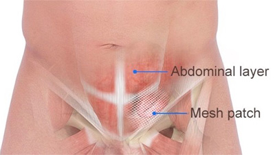 Inguinal Hernia Repair