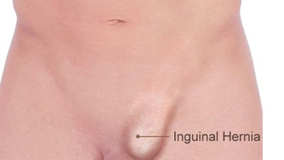 Inguinal Hernia Repair