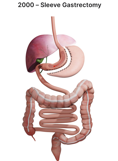 Sleeve bariatric procedures