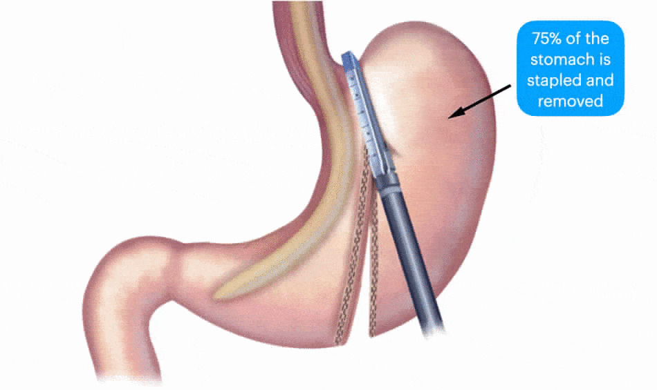 How does Sleeve Gastrectomy work?