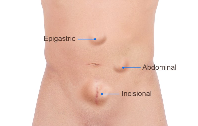 Ventral or Incisional Hernia Repair